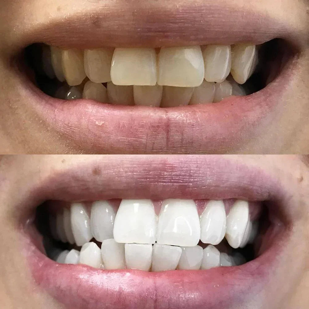 1+1 GRATIS | Pióro do wybielania zębów Diamond Smile