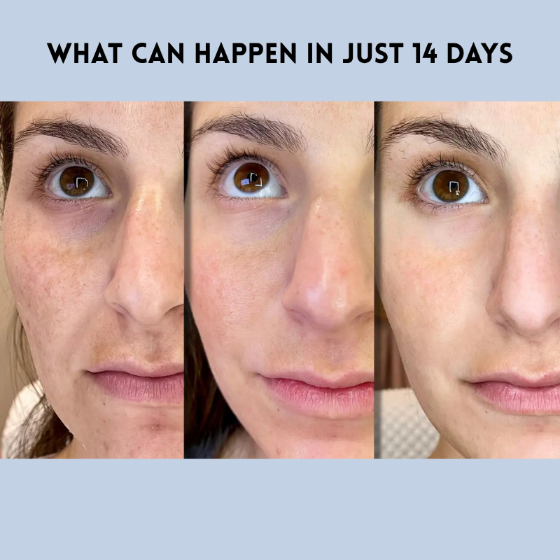 YouthLift™ Odnów paski – Natychmiastowe rozwiązanie dla ponadczasowego piękna