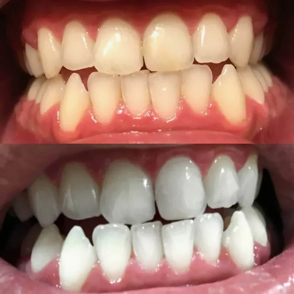 1+1 GRATIS | Pióro do wybielania zębów Diamond Smile