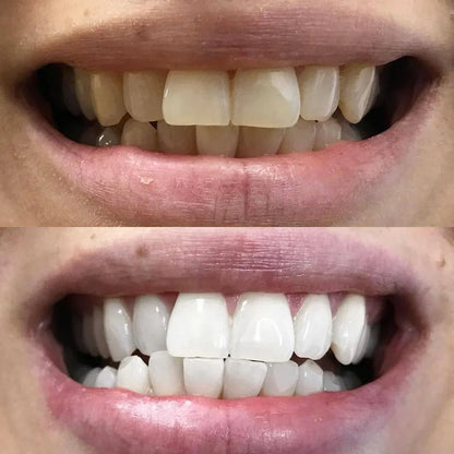 1+1 GRATIS | Pióro do wybielania zębów Diamond Smile