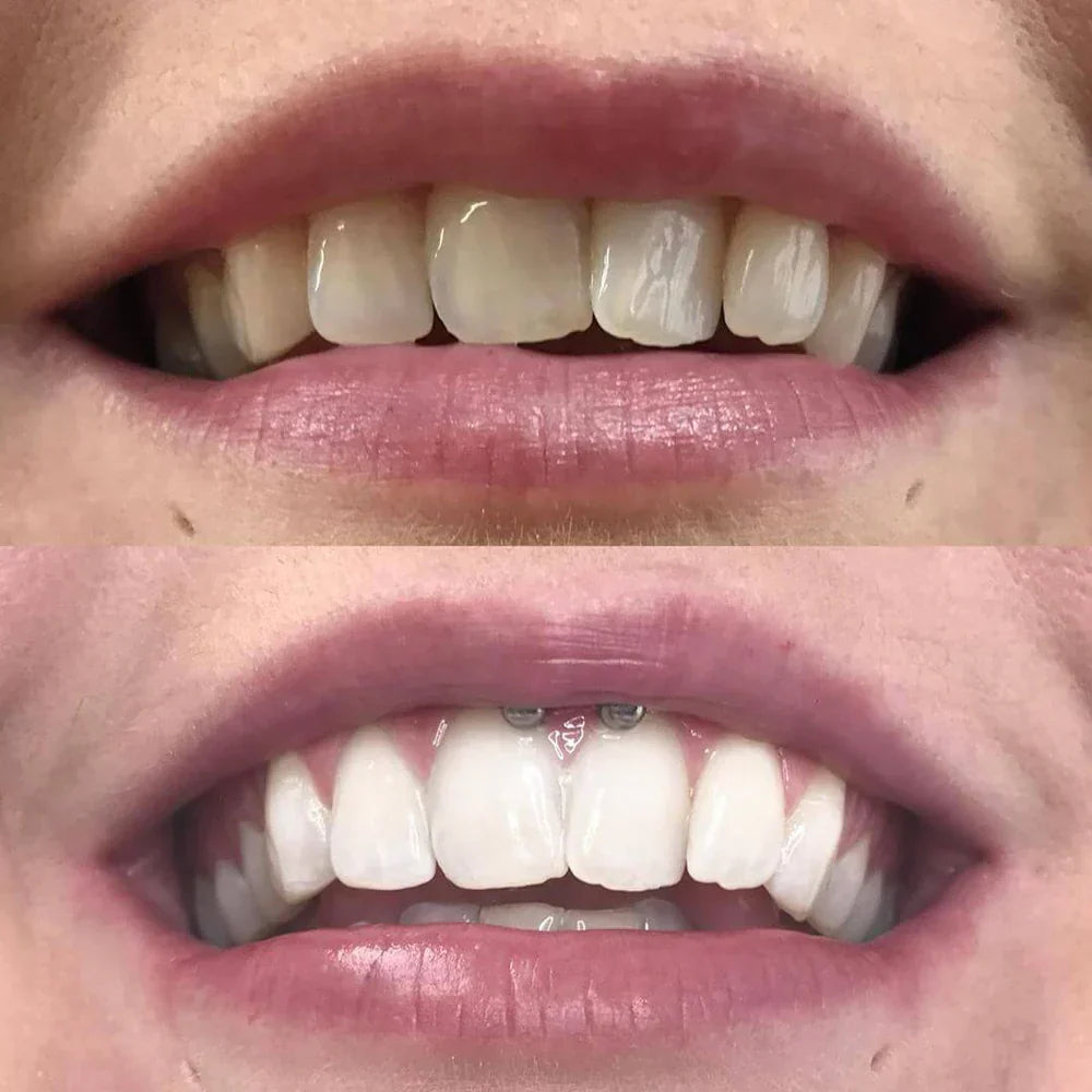 1+1 GRATIS | Pióro do wybielania zębów Diamond Smile